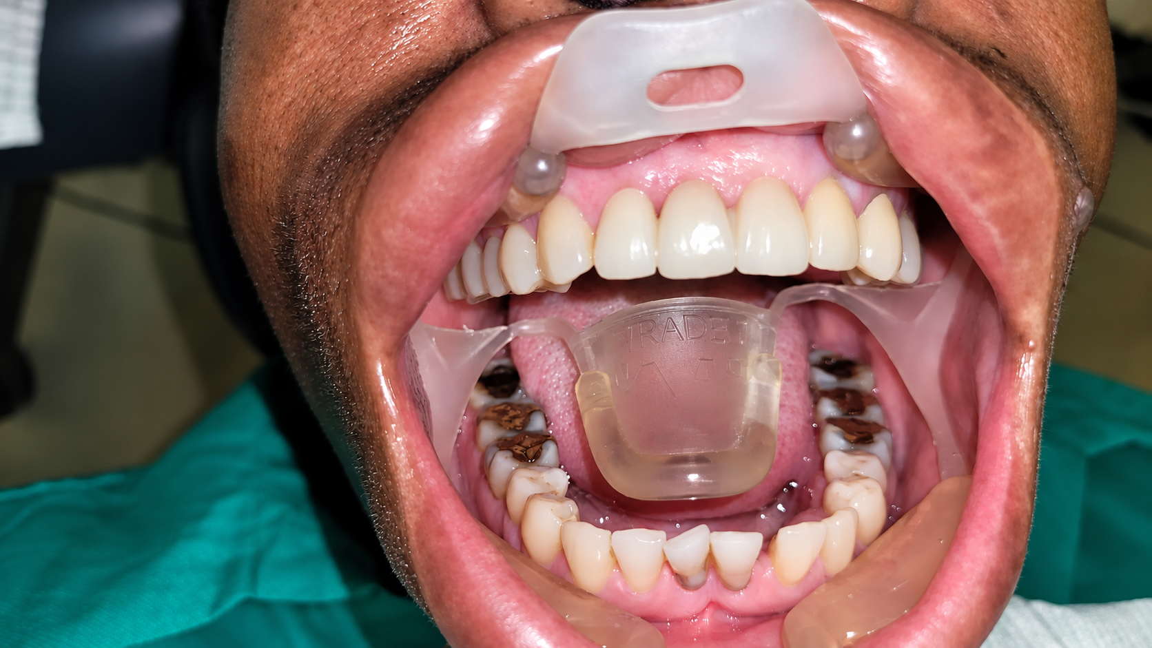 After dental treatment