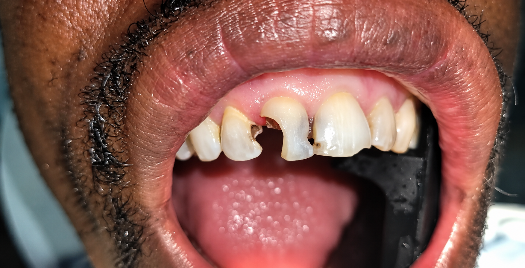 Before dental treatment